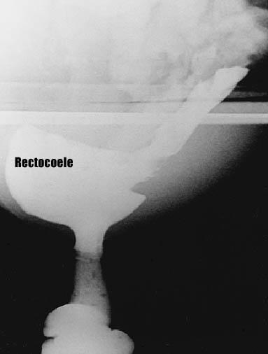 PROCTOGRAPHY RECTOCOELE